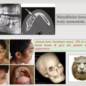 fibrousdysplasia 17 2048.webp